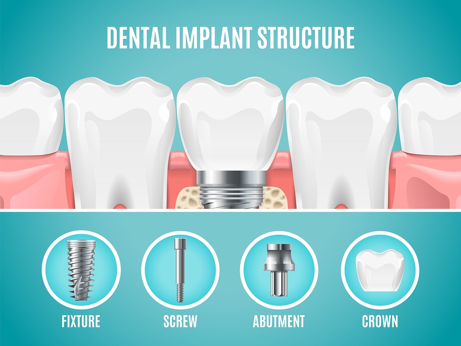 DENTAL IMPLANTS