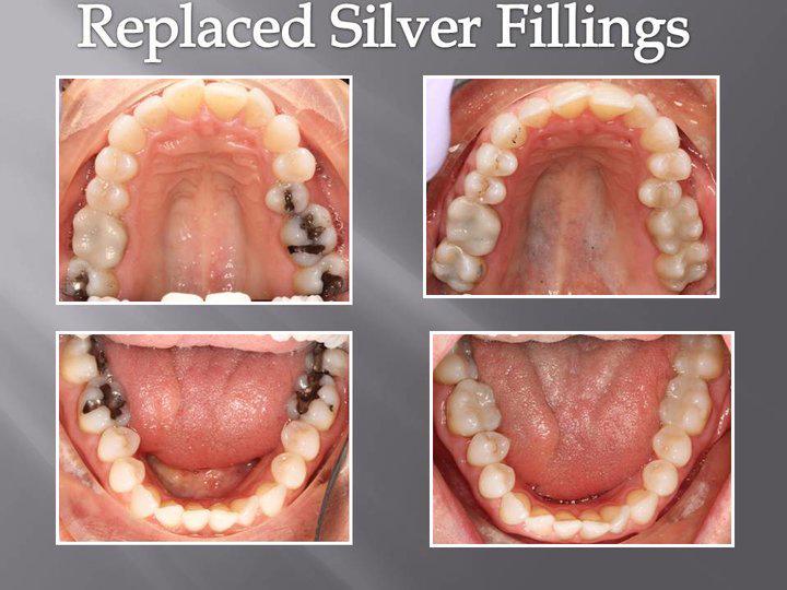 silver filling replacement
