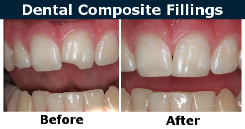 composite fillings