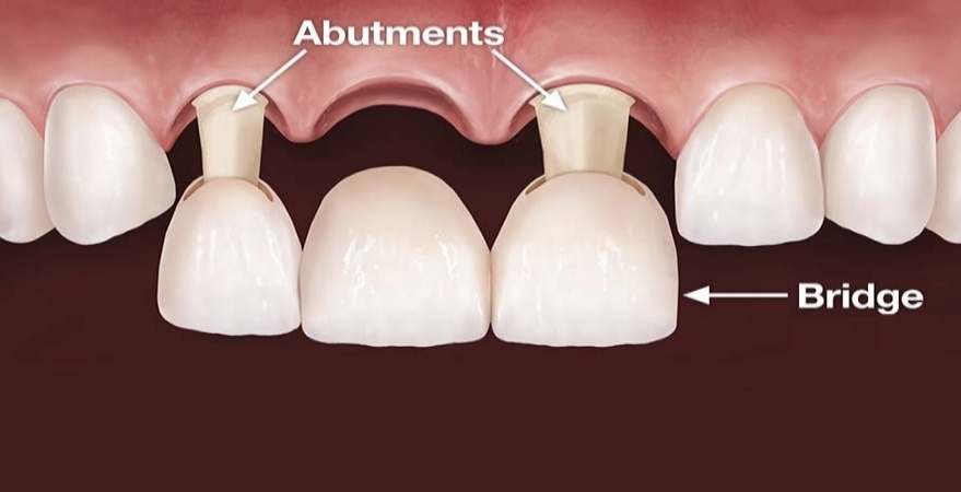 dental bridge